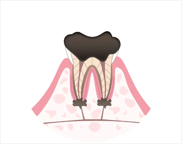 抜歯に至る重度の虫歯に