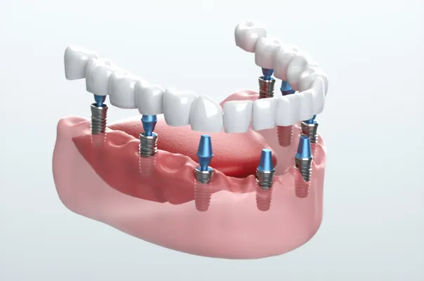 総入れ歯をインプラントに固定するオーバーデンチャー