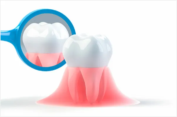 歯周病の進行・再発リスクを軽減