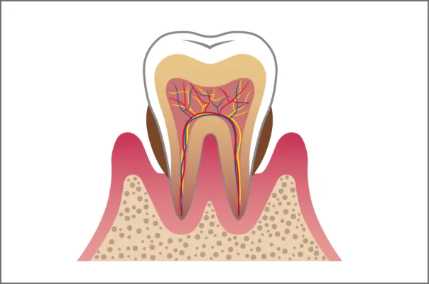 歯茎の腫れや出血は要注意